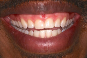 Samuel after chipped front teeth to a classic smile