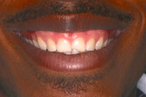 Samuel before chipped teeth