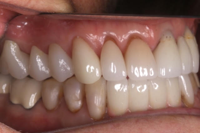 Anne “After” The Fixed Bridge on the upper right side Blends well with Anne’s other teeth.