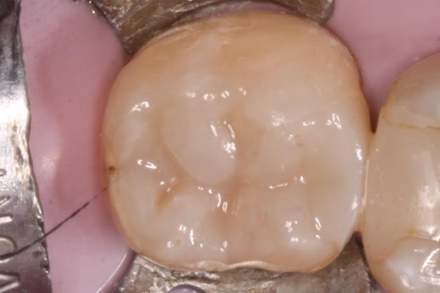 James After - The tooth has a bonded Natural-looking Composite that has nice chewing cusps for improved eating ability