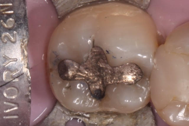 James Before - See the Crack in the Old Amalgam Metal Filling and the molar is turning Gray