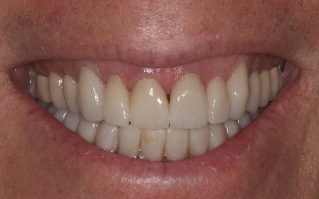 Kevin After - Veneer Replacement