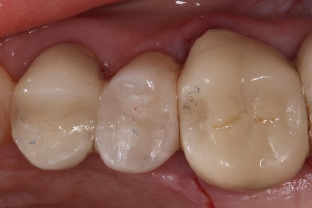 Laura After The bicuspid is Brighter and Whiter And the Contacts are Flossable