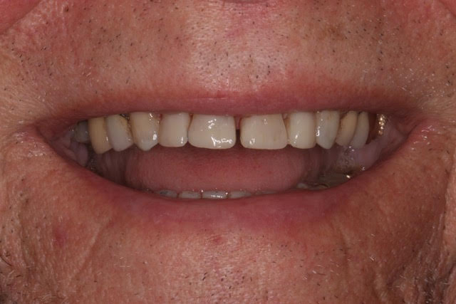 Lee After - Veneers