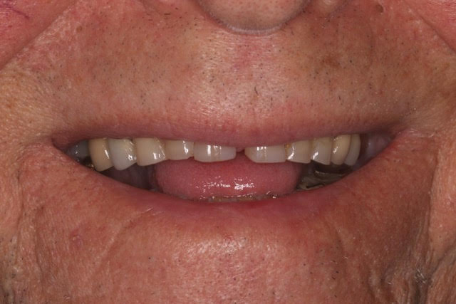Lee Before - Veneers