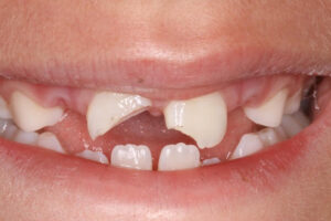 Sofia before chipped tooth repair