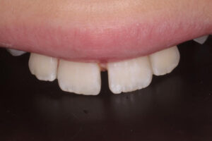 Alana After - Chipped Teeth