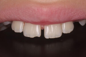 Alana Before - Chipped Teeth