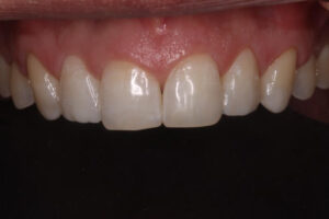 Danny After - Chipped Teeth