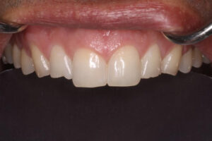 Danny Before - Chipped Teeth