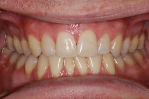 Jerry After - Chipped Teeth