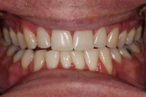 Jerry Before - Chipped Teeth