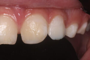 Kaia After - Chipped Teeth