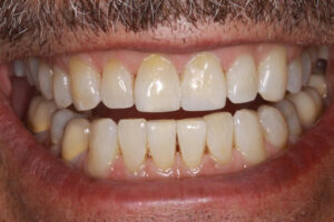 Len After - Chipped Teeth