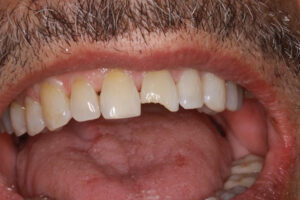 Len Before - Chipped Teeth