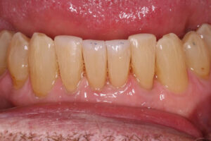 Mickey After - Chipped Teeth