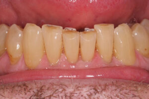 Mickey Before - Chipped Teeth