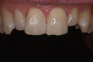 Mike Before - Chipped Teeth