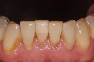 Stuart After - Chipped Teeth