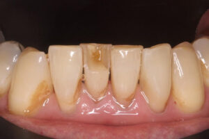 Stuart Before - Chipped Teeth