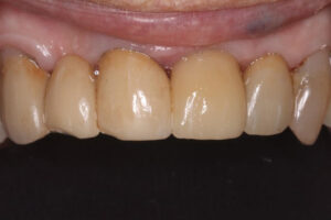 Virginia After - Chipped Teeth