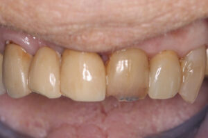Virginia Before - Chipped Tooth